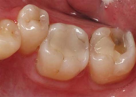 Dental Composite Fillings Everything You Should Know About