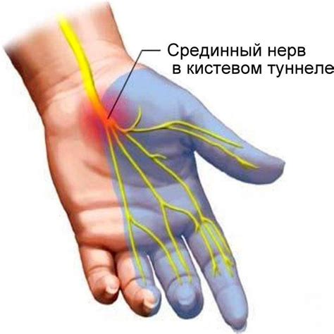 Туннельные синдромы. Синдром запястного канала