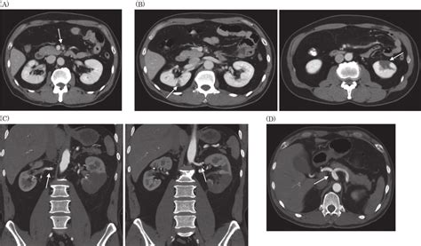 A Initial Contrast Enhanced Abdominal Computed Tomography Ct Showed