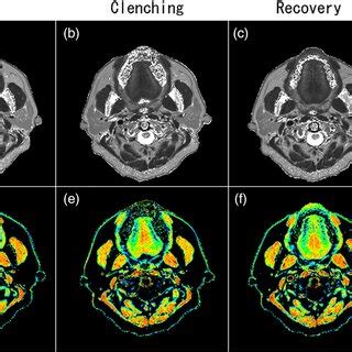 A C Representative Axial Plane T Weighted Mr Images Obtained At The