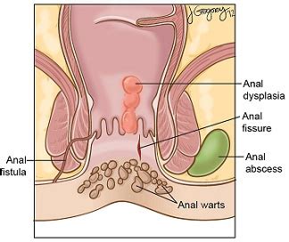 Condyloma Anal Rana Piles Hospital