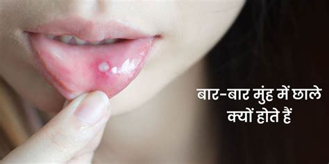 बार बार मुंह में छाले होने का कारण और राहत पाने के उपाय Mouth Ulcer