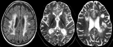 Subcortical Vascular Cognitive Impairment Similarities And Differences With Multiple Sclerosis