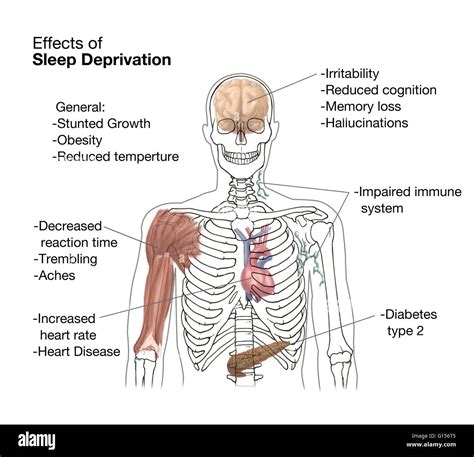 The Many Effects Of Sleep Deprivation Some Of These Include Stock