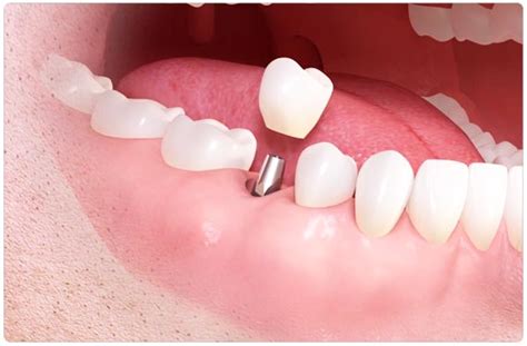 Computer Guided Implants Non Surgical Implants New Teeth Turkey