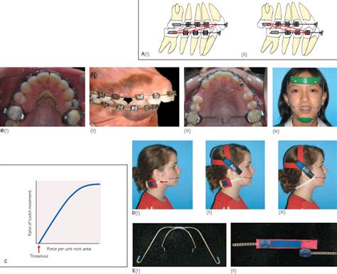 37 Anchorage Management Pocket Dentistry