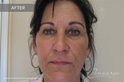 Before And After Juvederm Ultra And Botox 54 Yo Concierge Aesthetics