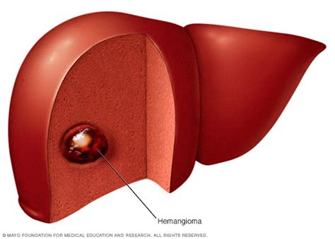 Liver hemangioma - Symptoms and causes - Mayo Clinic