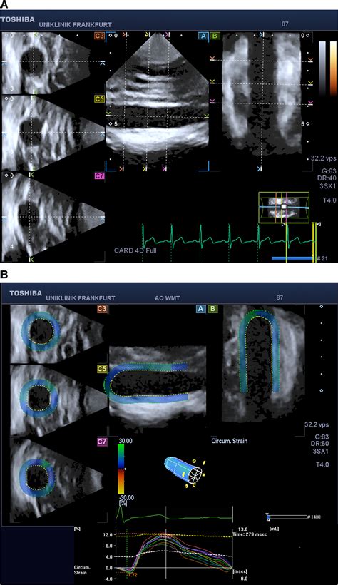 Intra And Interobserver Variability Of 4D Ultrasound Examination Of