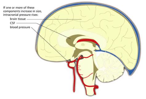 Intracranial Pressure Icp And Traumatic Brain Injury Tbi Nursing