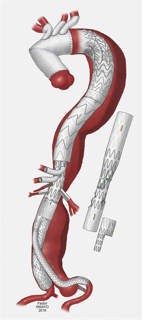 Technical Video Of Endovascular Repair Of Chronic Postdissection Thoracoabdominal Aortic