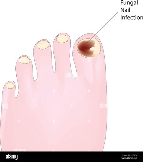 fungal nail infection Stock Vector Image & Art - Alamy