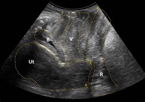 Translabial Us And Dynamic Mr Imaging Of The Pelvic Floor Normal