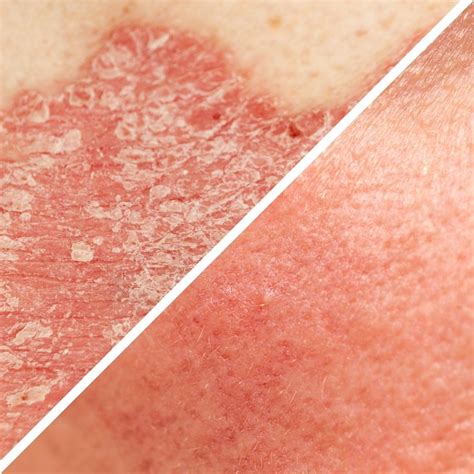 How Are Rosacea And Psoriasis Different Forces Of Nature Medicine