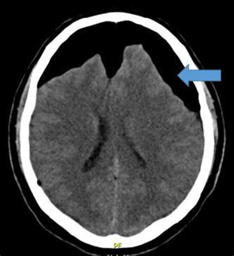 A Compression Bifrontal Supra And Infratentorial Pneumocephalus