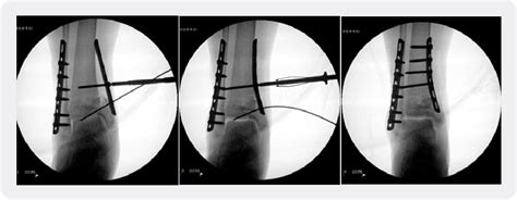 Figure 5 from Techniques in the Surgical Fixation of a Supination-Adduction Ankle Fracture ...