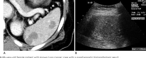 Figure 2 From Ultrasound Guided Percutaneous Core Needle Biopsy Of Splenic Lesions Semantic