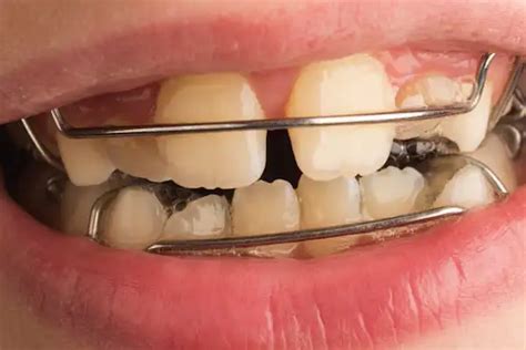 4 Most Common Signs You Need Braces Florida Independent