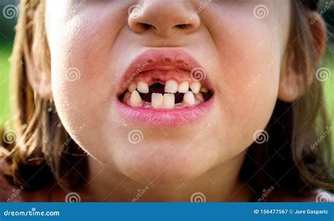 Portrait Of Toothless Child Girl Missing Milk And Permanent Teeth