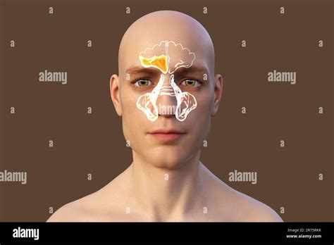 Sinus infection, or sinusitis, computer illustration. The sinuses are membrane-lined air-filled ...