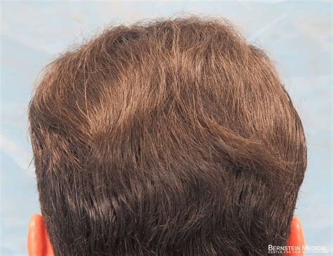 Crown Hair Transplant For Patient Znq Top Scalp Restoration