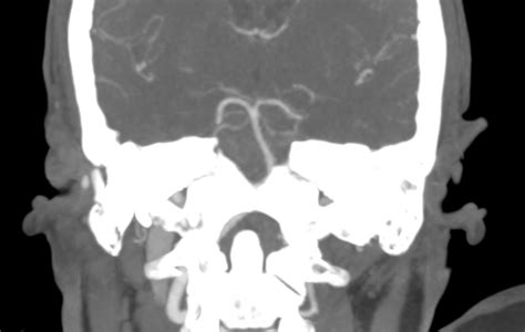 Perimesencephalic Subarachnoid Hemorrhage Image