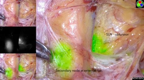 Not As Easy As It Seems Indocyanine Green Tracking And Anatomical