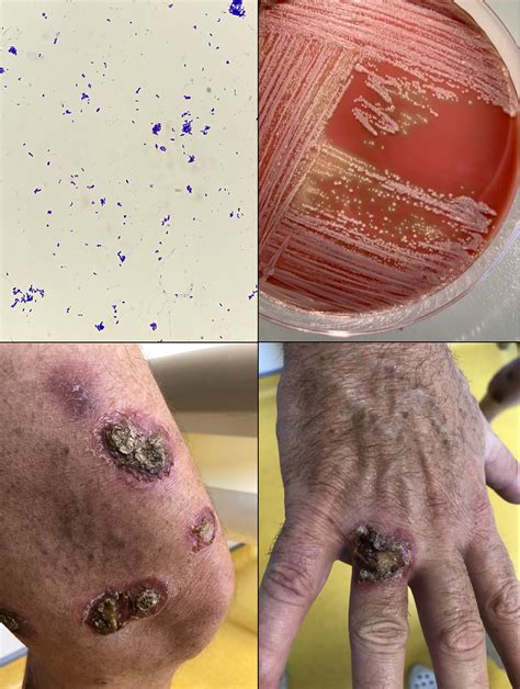 Cutaneous Diphtheria In A Patient Just Returned From Tahiti Clinical