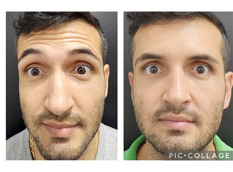 Botox Capilar Masculino Antes E Depois - Antes e Depois: Botox Masculino – Clínica Rasc | Itanhomi