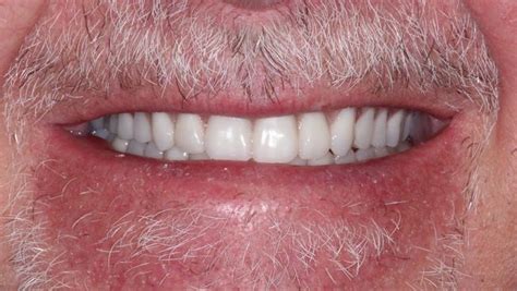 Case Full Upper Denture Lower Implant Retained Denture Dentures