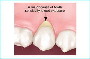 Sensitive Teeth Treatment in Noida | ID: 6970346730