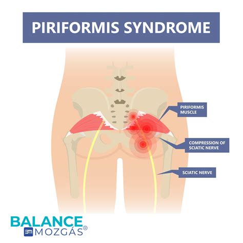 Piriformis Syndrome Rehabilitation Exercises Infographic Illust