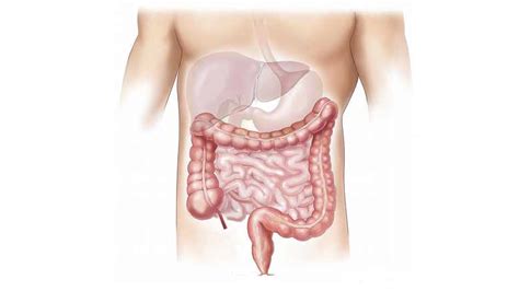 De Ziekte Van Crohn Symptomen Bestrijden Door De Juiste Voeding