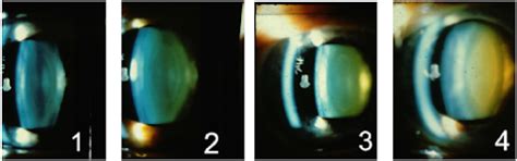 Ophthalmology Notes Grading Of Nucleus Hardness On Slit Lamp Biomicroscopy