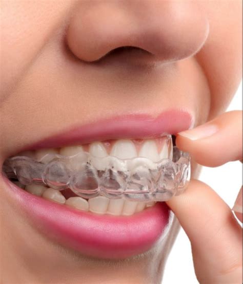 Invisalign And Gum Disease French Dental Services Dr Miski Dubai