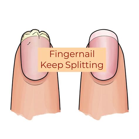 Fingernails Keep Splitting? Here's What To Do - Get Long Nails