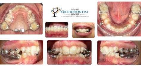 Guide On Various Dental Appliances Miami Orthodontist Group