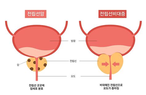 50대 남성의 건강불청객전립선암