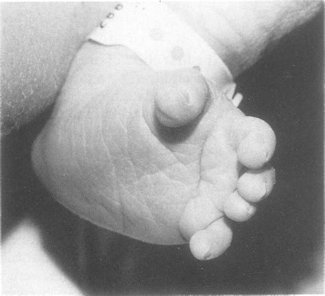 A Deep Transverse Plantar Crease Originating From A Wide Big Toe Cleft