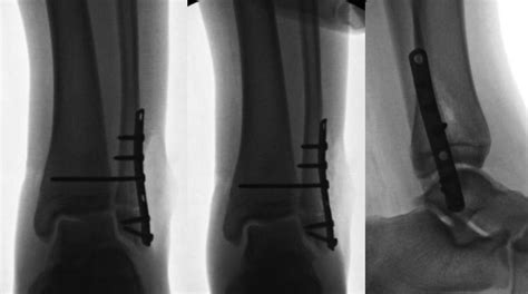 Case Anteroposterior Mortise And Lateral Radiographic Views Of The