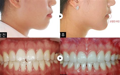 과개교합무턱증상 성장기교정 전후사진 에스플란트치과병원 교정과