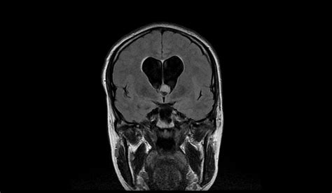 Colloid Cyst Mri Radiology Article On Colloid Cyst Of The Foramen Of Monro