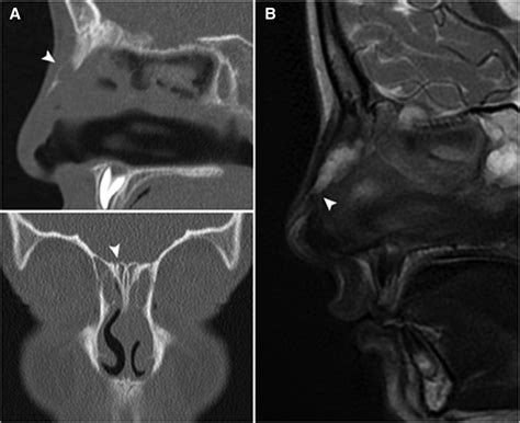 Nasal Dermoid Fistula The Journal Of Pediatrics