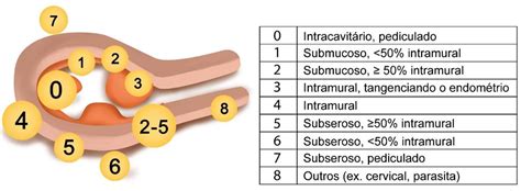Mioma Intramural Cresce A Barriga - Mioma Uterino: O que é e quais os tratamentos? - Dra Yedda Reis ...