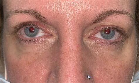 19 Upper Eyelid Surgery Before And After Photos Dallas Plano Texas Cosmetic Reconstructive