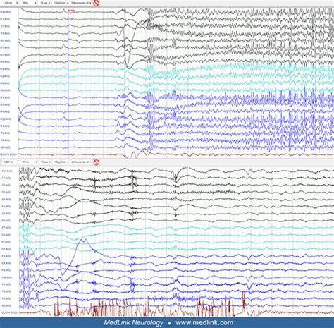 Absence Seizure