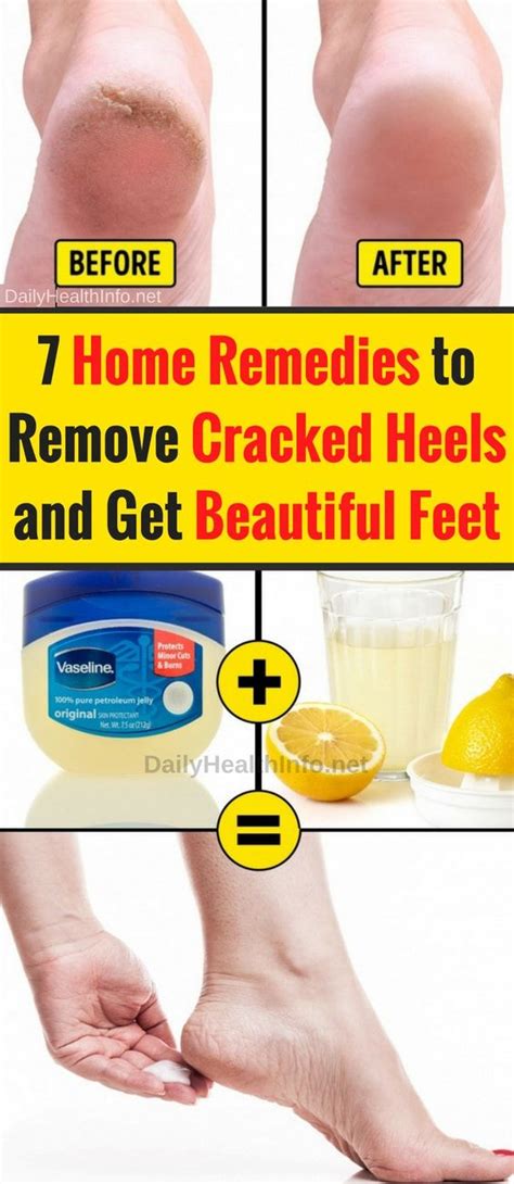 Dry Cracked Feet And How To Fix Them Steve Needs To Do This