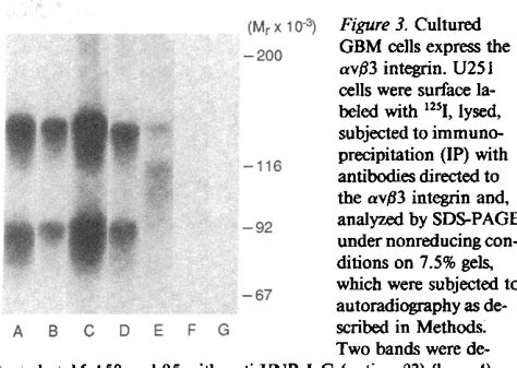 Figure From Glioblastoma Expression Of Vitronectin And The Alpha V