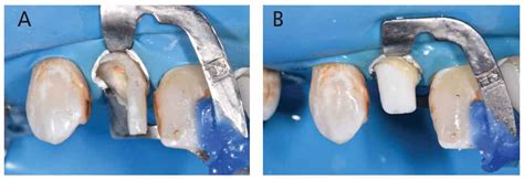 Rubber Dam Fig 20 Decisions In Dentistry