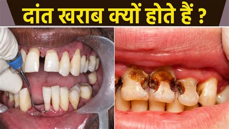 दत खरब हन क करण दत खरब कय हत ह Teeth Kyu Kharab